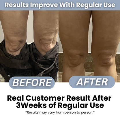 CelluGone™ - Anti Cellulite Roller + Massage Oil Kit